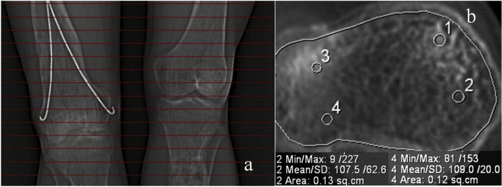 Detecting reasons for recurrent deformity in treatment of patients with vitamin D–resistant rickets using diagnostic imaging