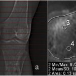 Detecting reasons for recurrent deformity in treatment of patients with vitamin D–resistant rickets using diagnostic imaging