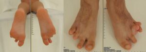 Technique for correction of combined burn scar deformity of foot